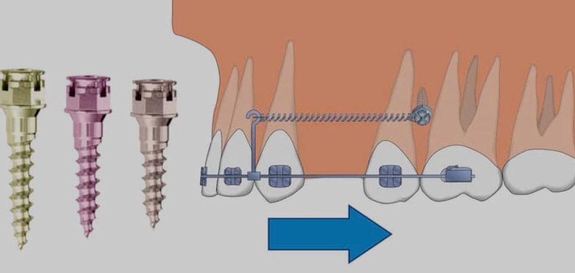 Micro implantes dentales