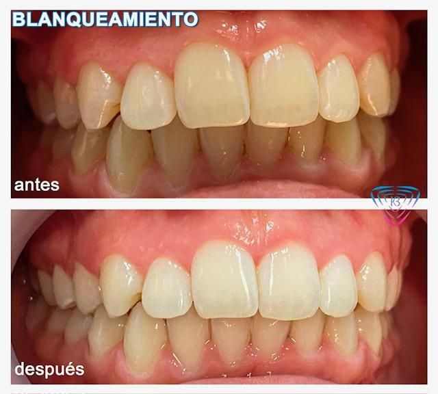 Antes y después de un blanqueamiento dental