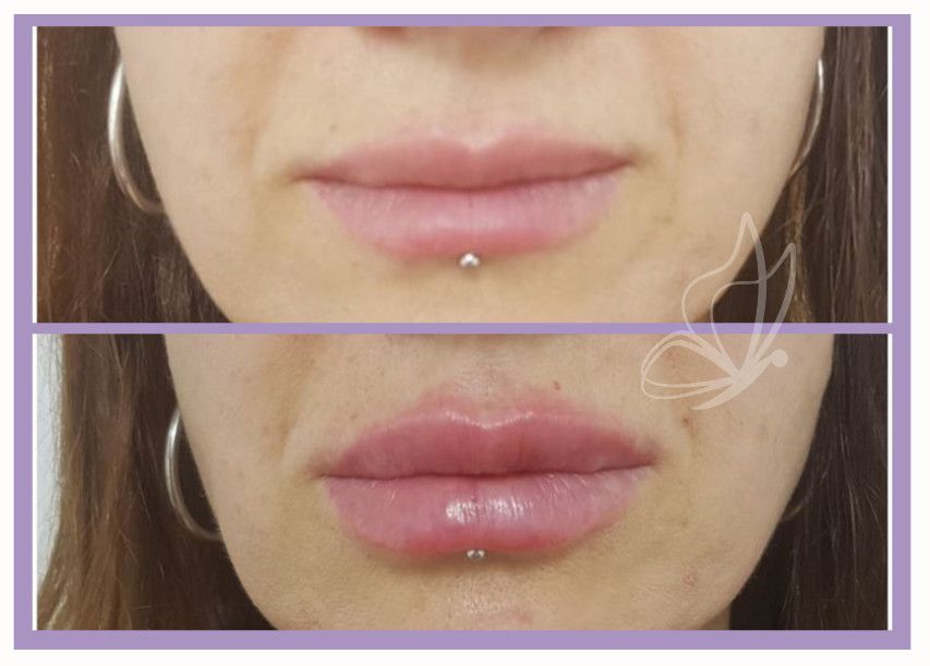 rostro de mujer antes y después de un relleno de labios