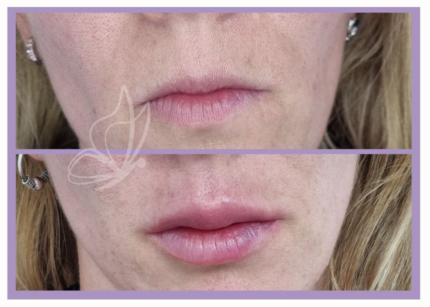 rostro de mujer antes y después de un relleno de labios
