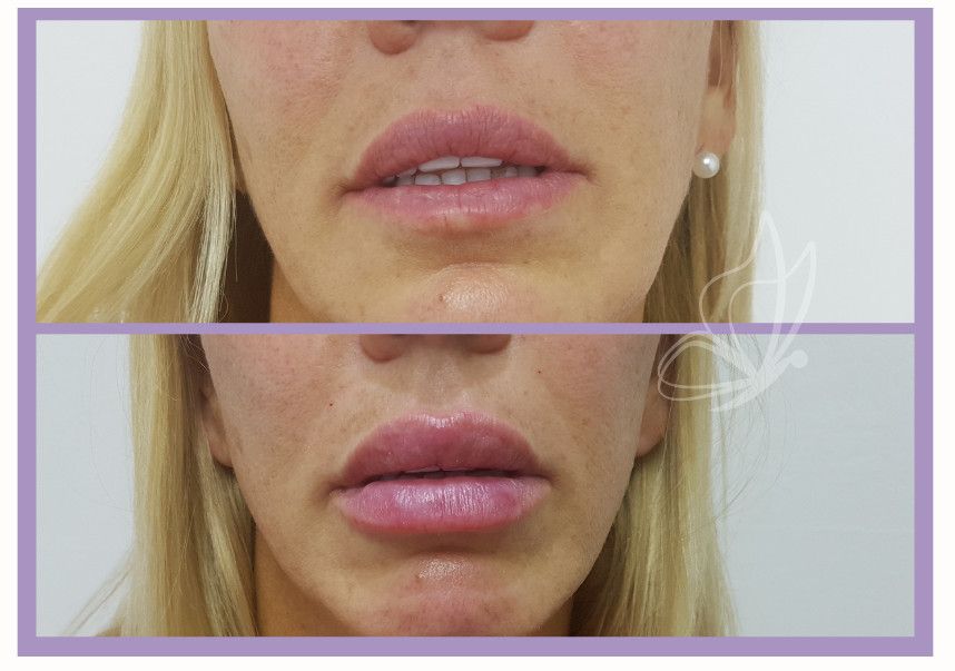 Rostro de mujer antes y después de un relleno de labios