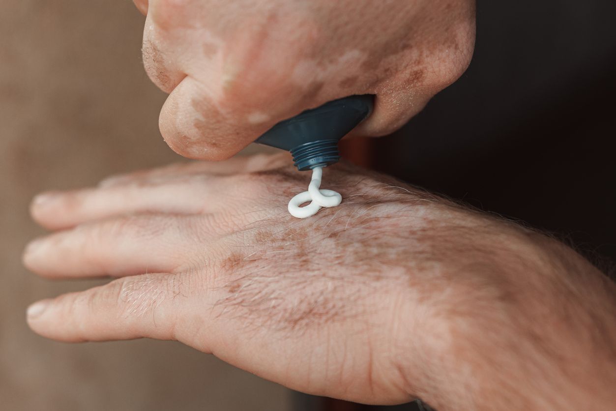 Tratamiento para el vitiligo