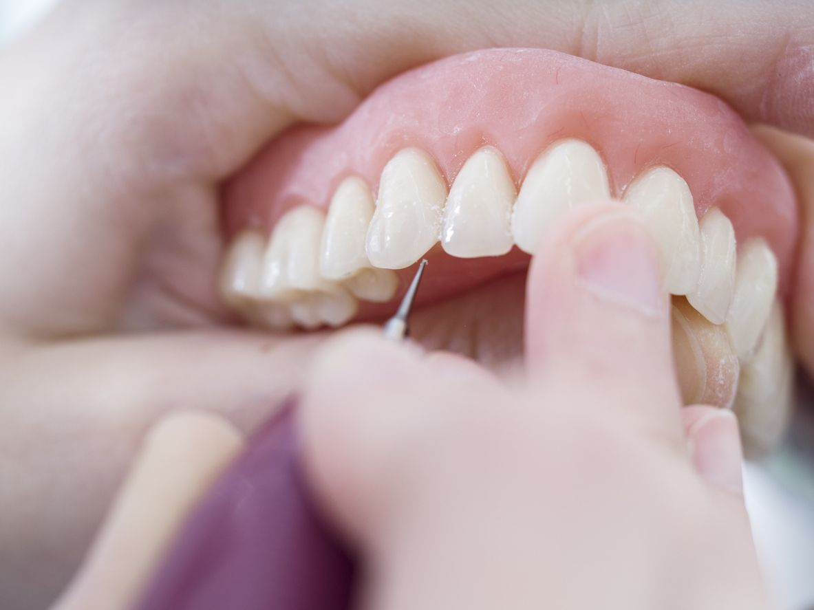 Prótesis dentales fabricadas y diseñadas a medida