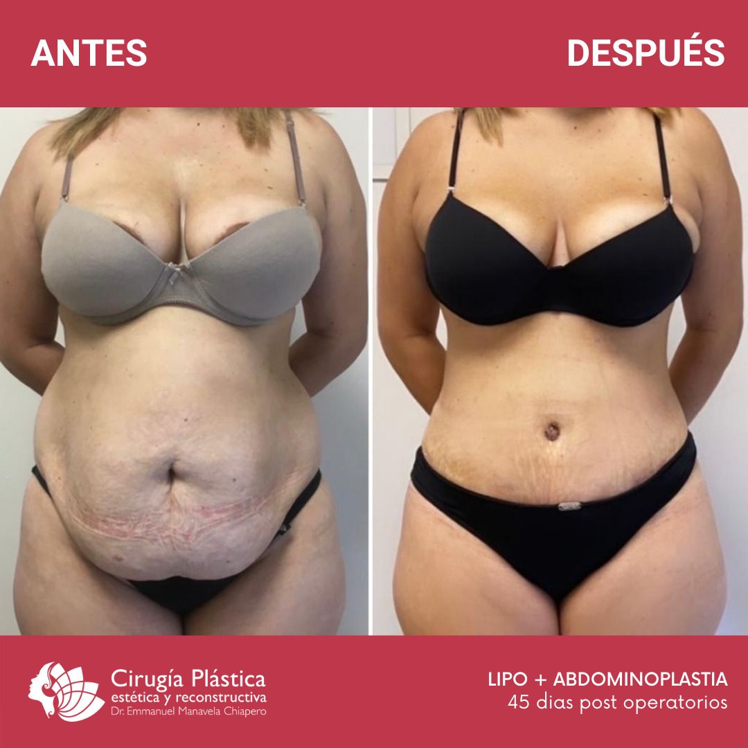 Antes y después de una liposución