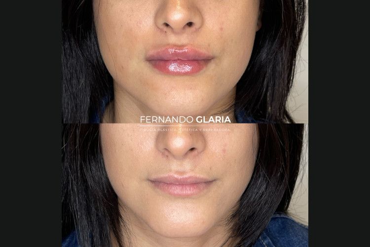 Mujer antes y después de un relleno de labios
