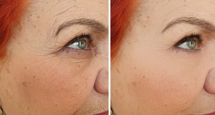 Endolaser antes y despues