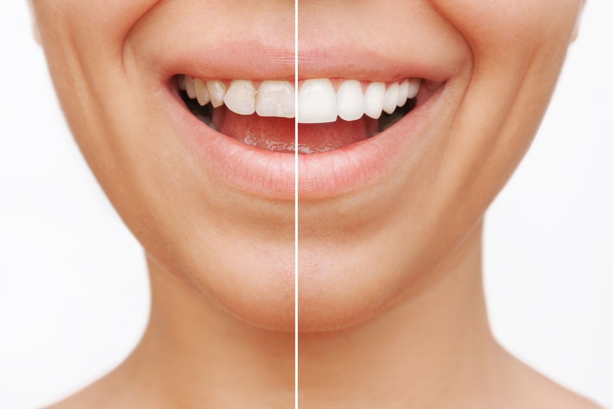las carillas de porcelana permiten tener unos dientes naturales manteniendo el brillo y el color de la dentadura.