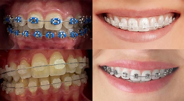 antes y después de una ortodoncia