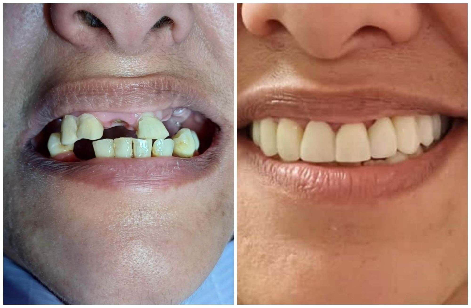 Antes y después de un implante dental