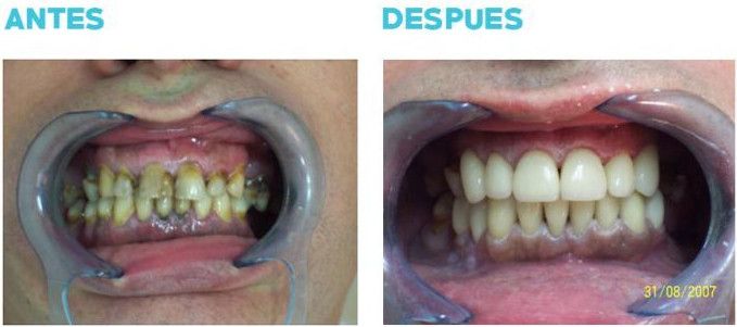 Antes y después de los implantes dentales