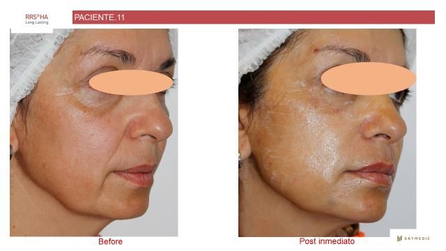Antes y después de una paciente que se hizo relleno facial