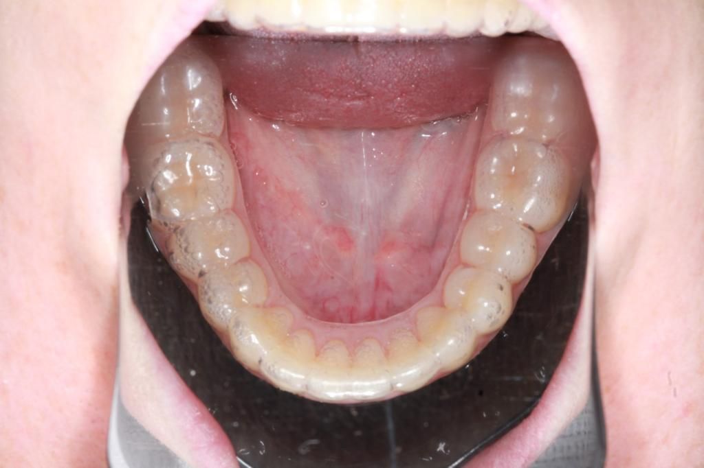 Ortodoncia invisble