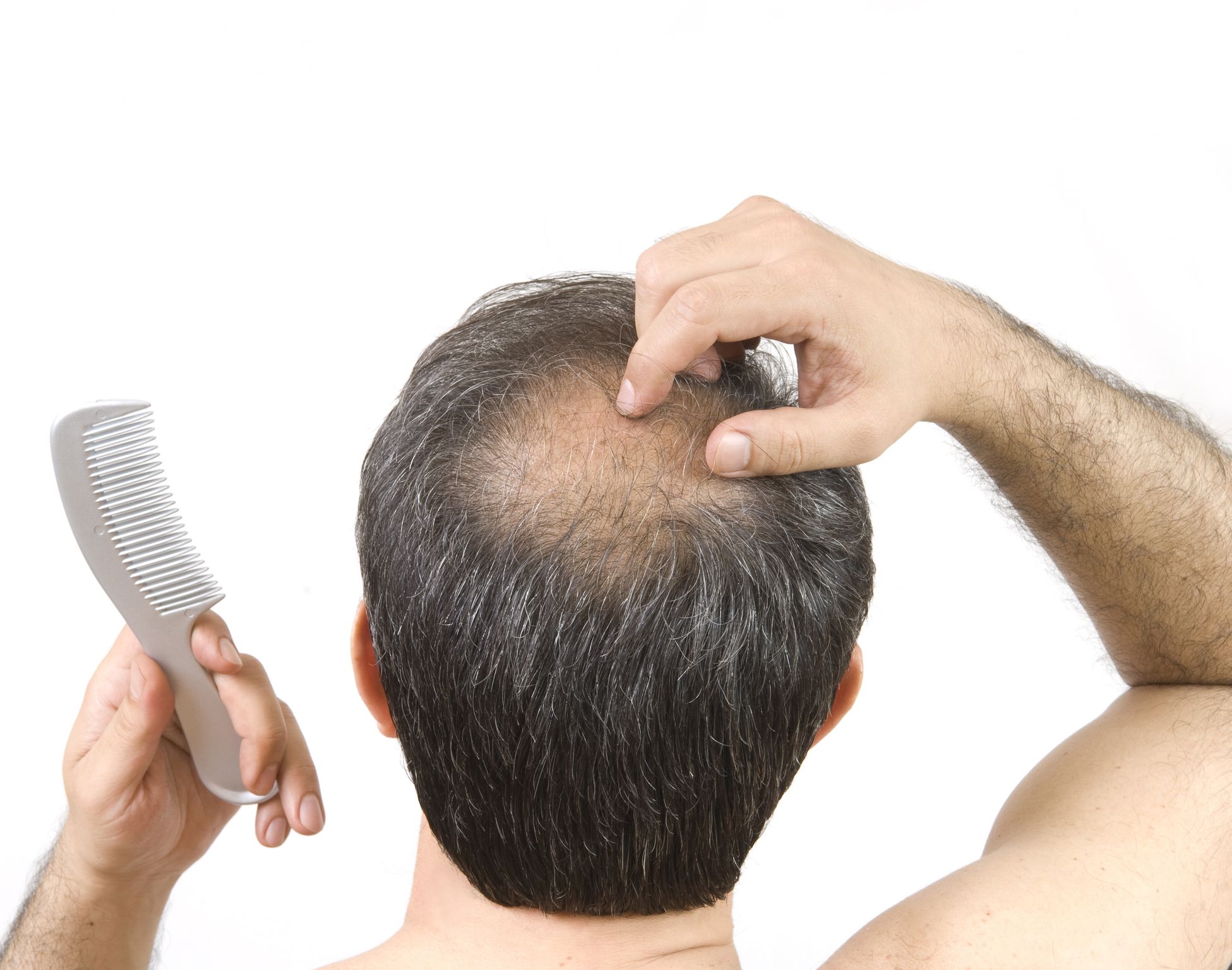 Implantes capilar para solucionar la caída de cabello