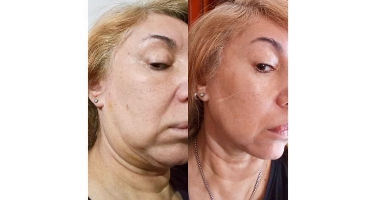 Antes y después endolift
