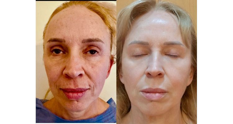 Resultados endolift