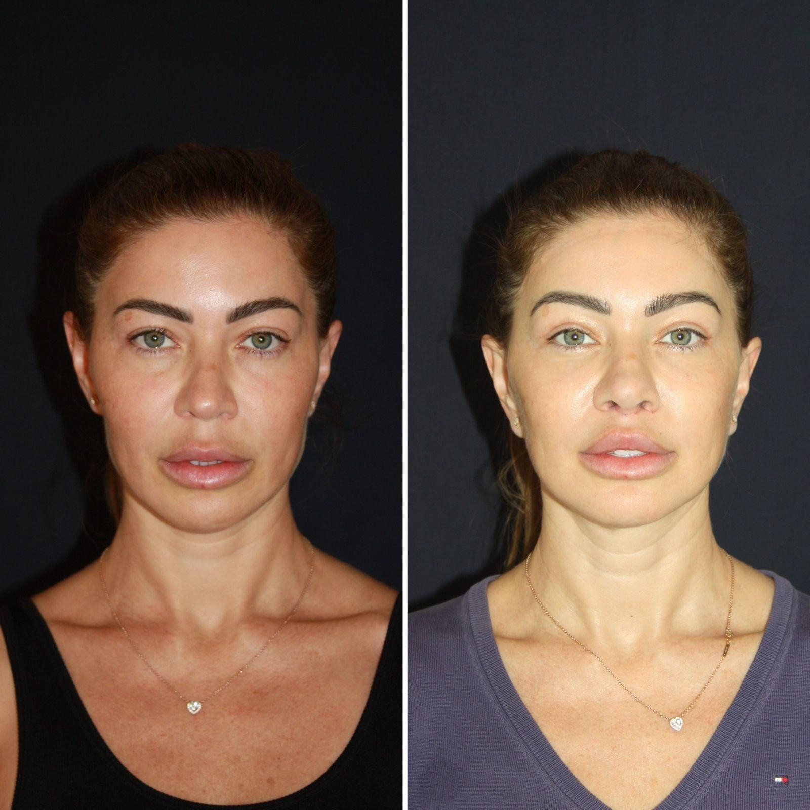 Rostro de mujer antes y después de un lifting facial MECA