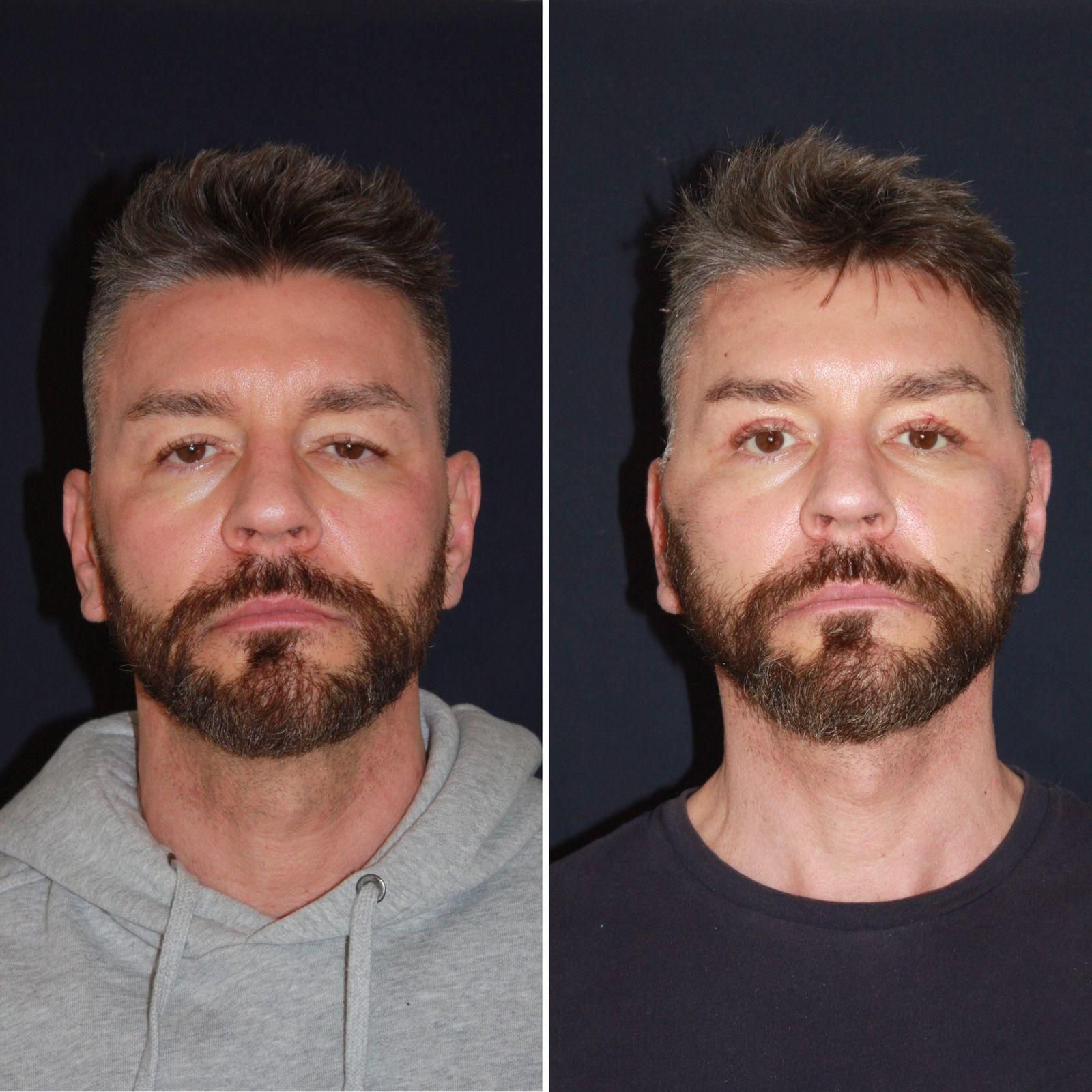 Rostro masculino antes y después del linfting facial MECA