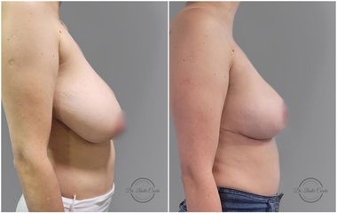 Mastopexia - Dr. Nadir Carda