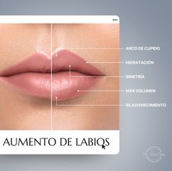 Aumento de Labios con Ácido Hialurónico - Dr.Nadir Carda