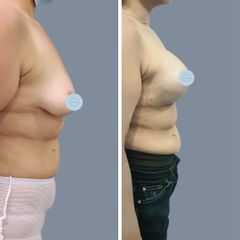 Mastopexia con implantes - Dr. Nadir Carda