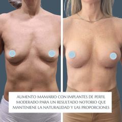 Aumento Mamario - Dr. Nadir Carda