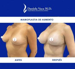 Mamoplastia de aumento - Dra. Daniela Stephania Vaca Grisales