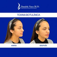 Toxina botulínica - Dra. Daniela Stephania Vaca Grisales
