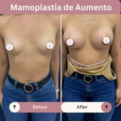 Mamoplastia de aumento - Dra. Daniela Stephania Vaca Grisales