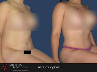 Antes y despues de abdominoplastia