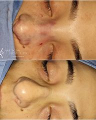 Rinoplastia - Dr. Milton Horacio Rincón Carranza