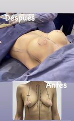Mamoplastia de aumento - Dra. Erika Gutiérrez