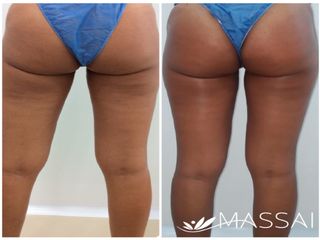 Tratamiento Massup - Tonificación Gluteos y Celulitis