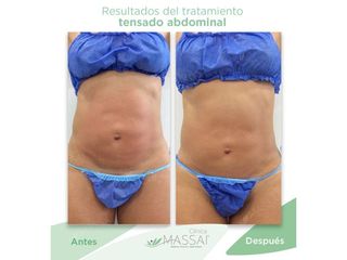 Tensado abdominal - Massai