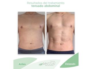 Tensado abdominal - Massai