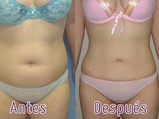 Antes y después de lipoescultura