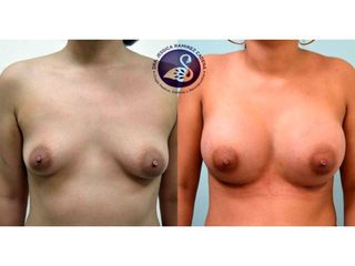 Antes y después de Aumento de busto