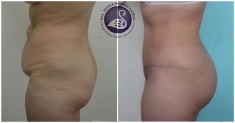 Antes y después de Abdominoplastia