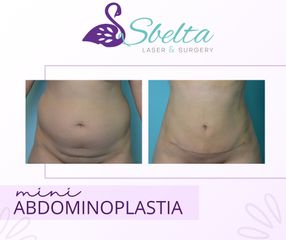 Miniabdominoplastia - Dra. Jessica Ramírez Cadena