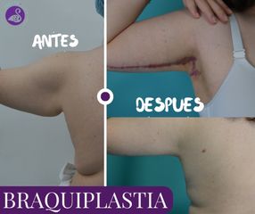 Braquiplastía - Dra. Jessica Ramírez Cadena