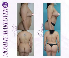 Mommy Makeover - Dra. Jessica Ramírez Cadena