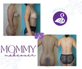 Mommy Makeover - Dra. Jessica Ramírez Cadena