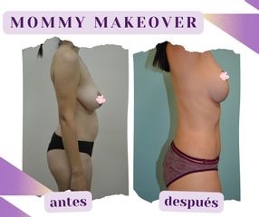 Mommy Makeover - Dra. Jessica Ramírez Cadena