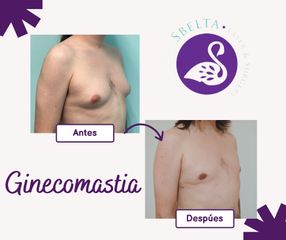 Ginecomastia - Dra. Jessica Ramírez Cadena