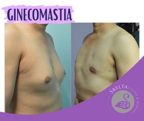 Ginecomastia - Dra. Jessica Ramírez Cadena