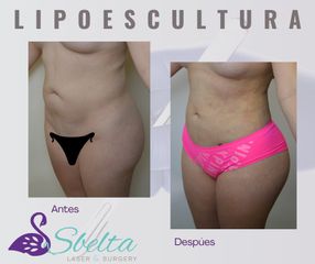 LIPOESCULTURA - Dra. Jessica Ramírez Cadena