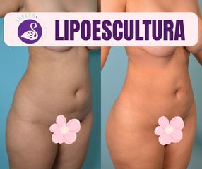 LIPO 360 - Dra. Jessica Ramírez Cadena
