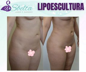 LIPOESCULTURA - Dra. Jessica Ramírez Cadena