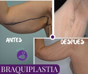 BRAQUIPLASTIA - Dra. Jessica Ramírez Cadena