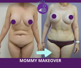 Mommy Makeover - Dra. Jessica Ramírez Cadena
