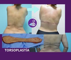 Torsoplastía - Dra. Jessica Ramírez Cadena